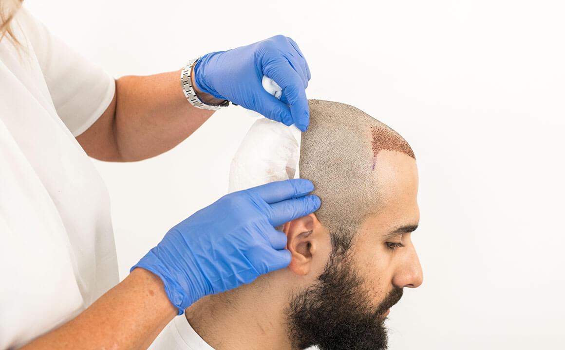 Hair Transplant in London