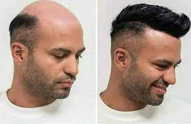 hair restoration manchester