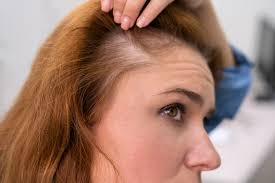 hair loss treatment