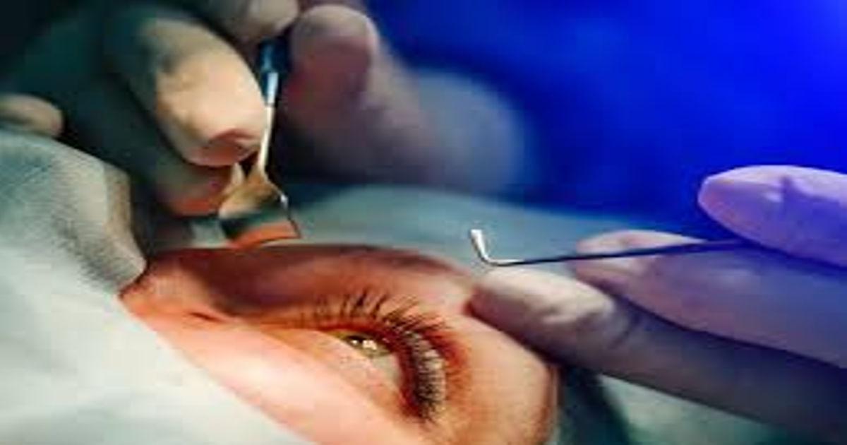 cataract surgery