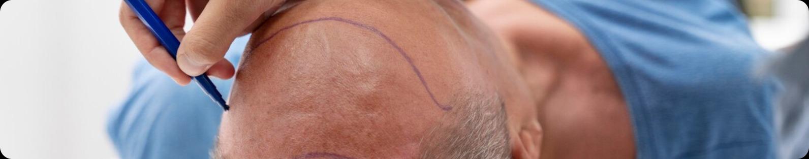 FUE hair transplant London