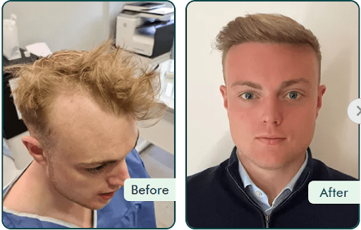 FUE hair transplant London